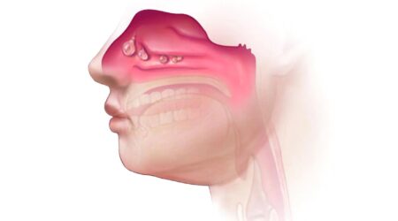 Nasal-Polyposis